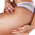 40 Ways to Get Rid of and Prevent Stretch Marks - ₽ 10.00