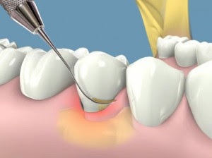Cao răng huyết thanh có hại không?