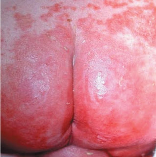 Severe rashes on the baby buttocks due to constant contact of the diaper