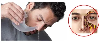 للقضاء على انسداد الجيوب الأنفية !!! نقترح عليك حلا بسيطا.المرجوا النشر