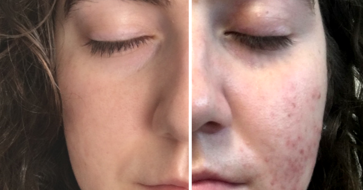 Tretinoin (Retin-A) - Before and After Acne | Katie McManus
