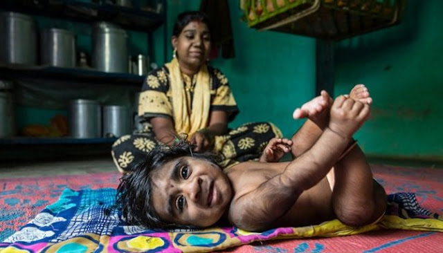 Kisah Manisha, Seorang Ibu Yang Melahirkan Anak Pengidap Hipertrikosis
