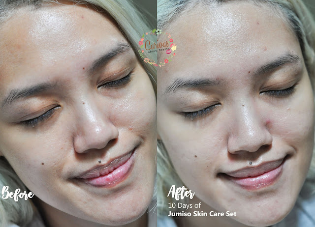 before after Jumiso Skin Care Set
