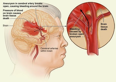 Cara Mengobati Penyakit Stroke Secara Tradisional