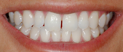 Vì sao nên thẩm mỹ răng bị thưa?