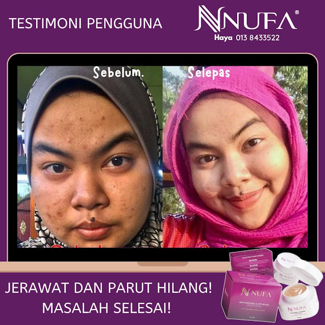 TESTIMONI NUFA TREATMENT MOISTURIZER