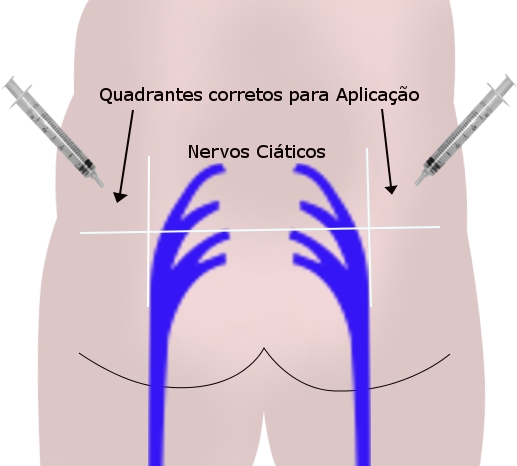 APLICAÇÃO INTRAMUSCULAR NO GLÚTEO YouTube