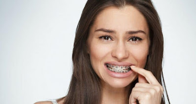 Tư vấn niềng răng giai đoạn nào đau nhất cho khách hàng-1