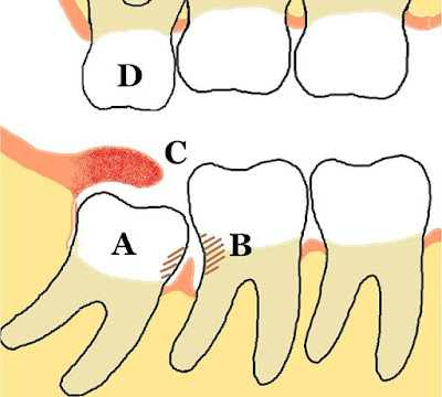  Nhổ răng khôn mọc lệch tại nha khoa