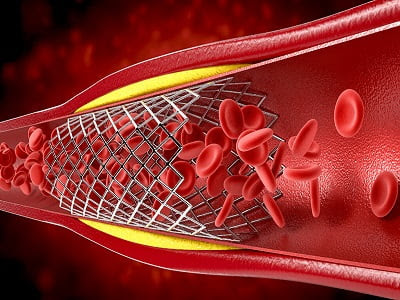 United States Stent Market - TechSci Research