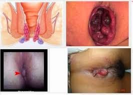  http://12cavertaveegagenericviagrvfg.blogspot.com/2015/04/mengatasi-wasir-berdarah-saat-hamil.html