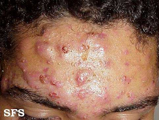 prescription acne medication accutane,