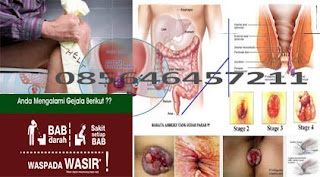 Artikel AmbeJOSS Obat Wasir Wikipedia