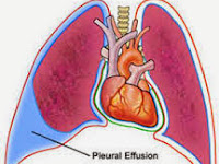 NCP for Disturbed Sleep Pattern related to Pleural Effusion