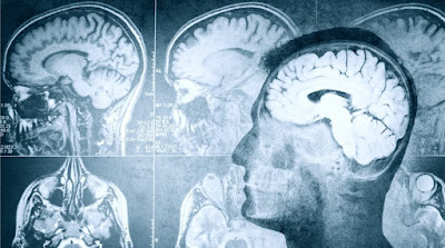 Η νευροαπεικόνιση για τον "εγκληματικό εγκέφαλο": δομικές αλλαγές στον εγκέφαλο ανιχνεύουν ή προβλέπουν... εγκληματική δράση (;)