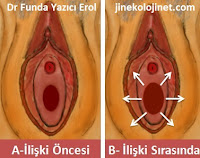 esnek kızlık zarı