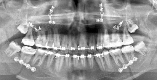 x-ray after bimaxillary osteotomy