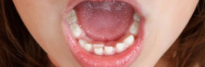 Double Teeth Problem Meaning, Symptoms, Causes, Treatment