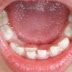 Double Teeth Problem Meaning, Symptoms, Causes, Treatment