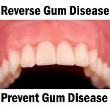 reversing gum disease, gum, Gingivitis, Gingivitis Treatment, Gingivitis Treatment at Home, Behaviors, 