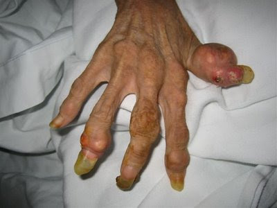Anorexia Nervosa; Bulimia Nervosa Hand of a 46-year-old anorexic woman