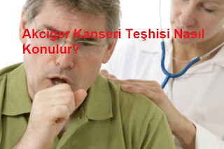 Akciğer Kanseri Teşhisi Nasıl Konulur?