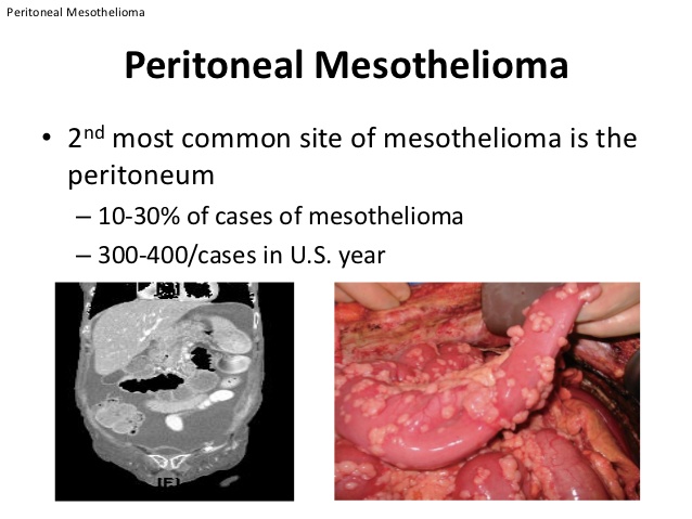 Peritoneal Mesothelioma