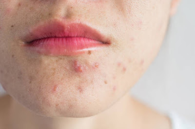 Pustules
