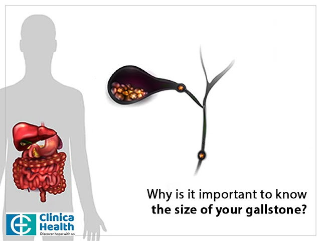 gallstone