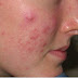 What are Whiteheads acne and what causes Whiteheads on face and especially on nose