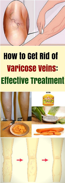 How To Get Rid Of Your Varicose Veins: Effective Treatment!!!