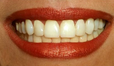 Tổng hợp những nguyên nhân răng bị vàng và cách phòng tránh
