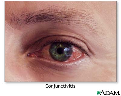 pink eye infection. Eye Infection Symptoms