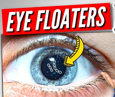 Facts About Eye Floaters