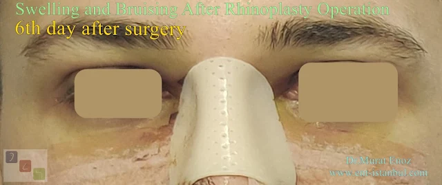 Benefits of intavenous cortisone injection during rhinoplasty surgery,Swelling after rhinoplasty,Bruising after rhinoplasty,Cortisone injections for bruising and swelling in rhinoplasty operations,