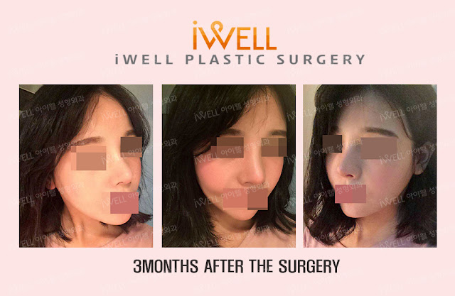Plastic Surgery in Korea