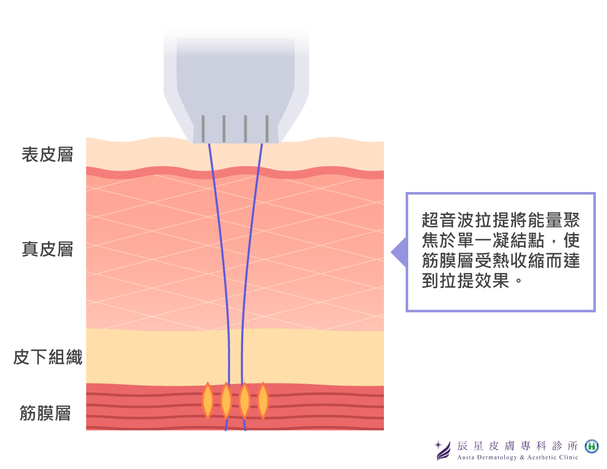 超音波拉提