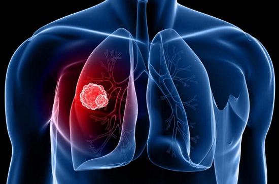 Gejala dan Penyebab  Pemicu Kanker  Paru paru  Penyakit 