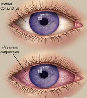  Konjungtivitis Alergika yaitu suatu peradangan alergi pada konjungtiva   Konjungtivitis Alergika