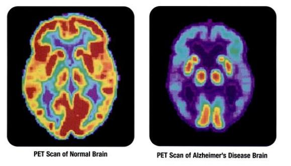 Alzheimer's test PET