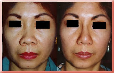 asian rhinoplasty