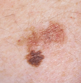 skin cancer white spots