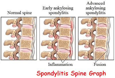 symptoms of ankylosing spondylitis flare up