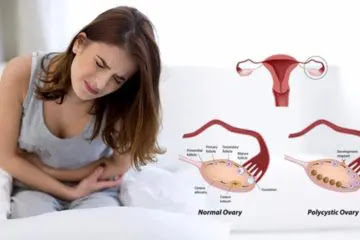 Polycystic Ovary Disorder (PCOS) Symptoms And Treatment.