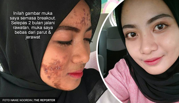 Inilah Gambar Muka Saya Semasa Breakout Tapi Dah Pulih Selepas Jalani Rawatan Rm300 The Reporter