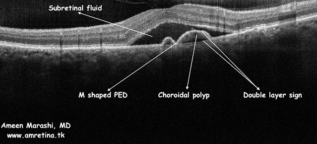 OCT Cross-section showing PCV in M shaped PED and double-layer sign with subretinal fluid