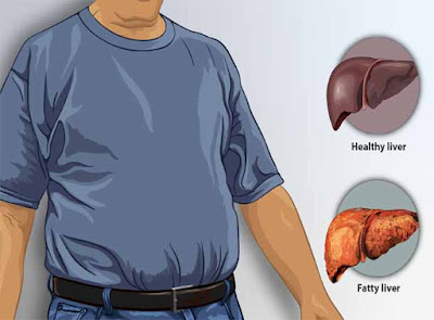 Fatty Liver Disease: Risk Factors Symptoms, Diet & General Treatments
