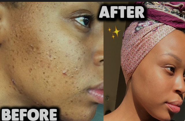 Hormonal Acne Skincare Routine for Black Skin: Expert tips