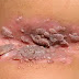 Gambar Kutil Pada Kemaluan Wanita thumbnail