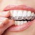 Tìm hiểu về niềng răng không mắc cài 3D Clear 